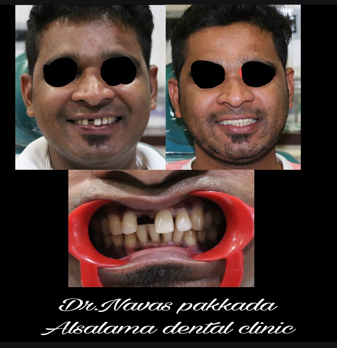 Anterior Space closure
